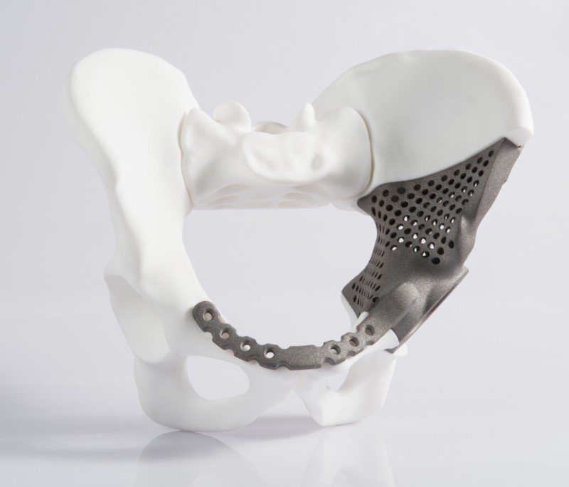 3d-printed metal pelvic implant model in white and gray, demonstrating medical technology for bone replacement.