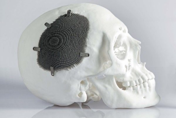 A human skull model with a dark textured patch secured by 3D metal printing screws on its side, set against a white background.