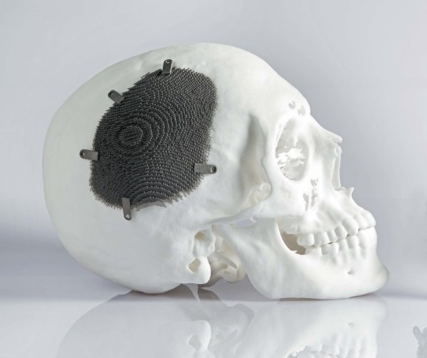 A human skull model with a dark textured patch secured by 3D metal printing screws on its side, set against a white background.